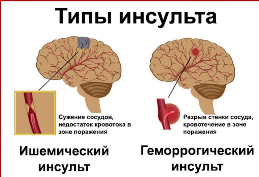 «Школа здоровья «Жизнь после инсульта»